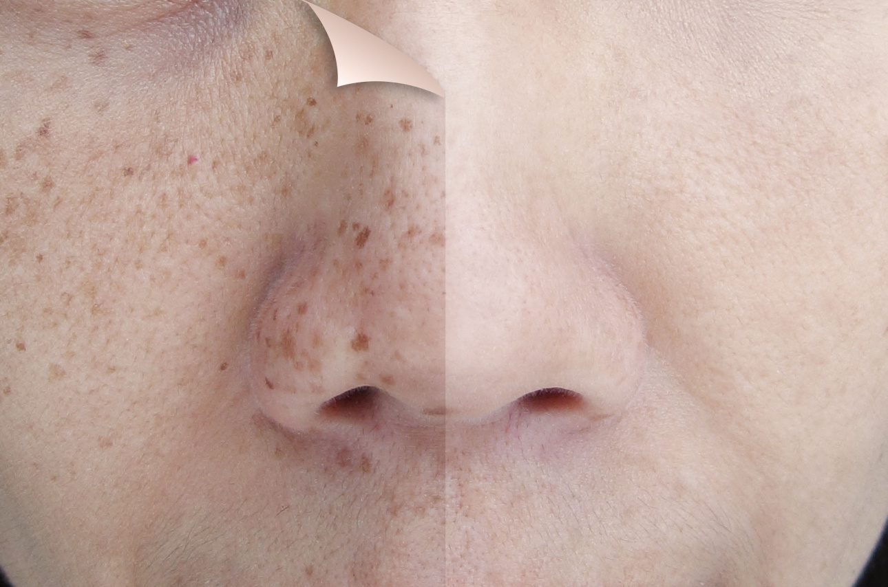 Manfaat Moisturizer, membantu mencerahkan flek hitam