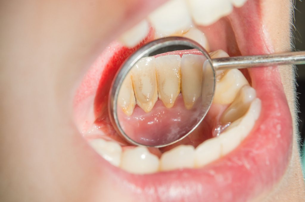 Tips Ampuh dan Mudah Menghilangkan Karang Gigi
